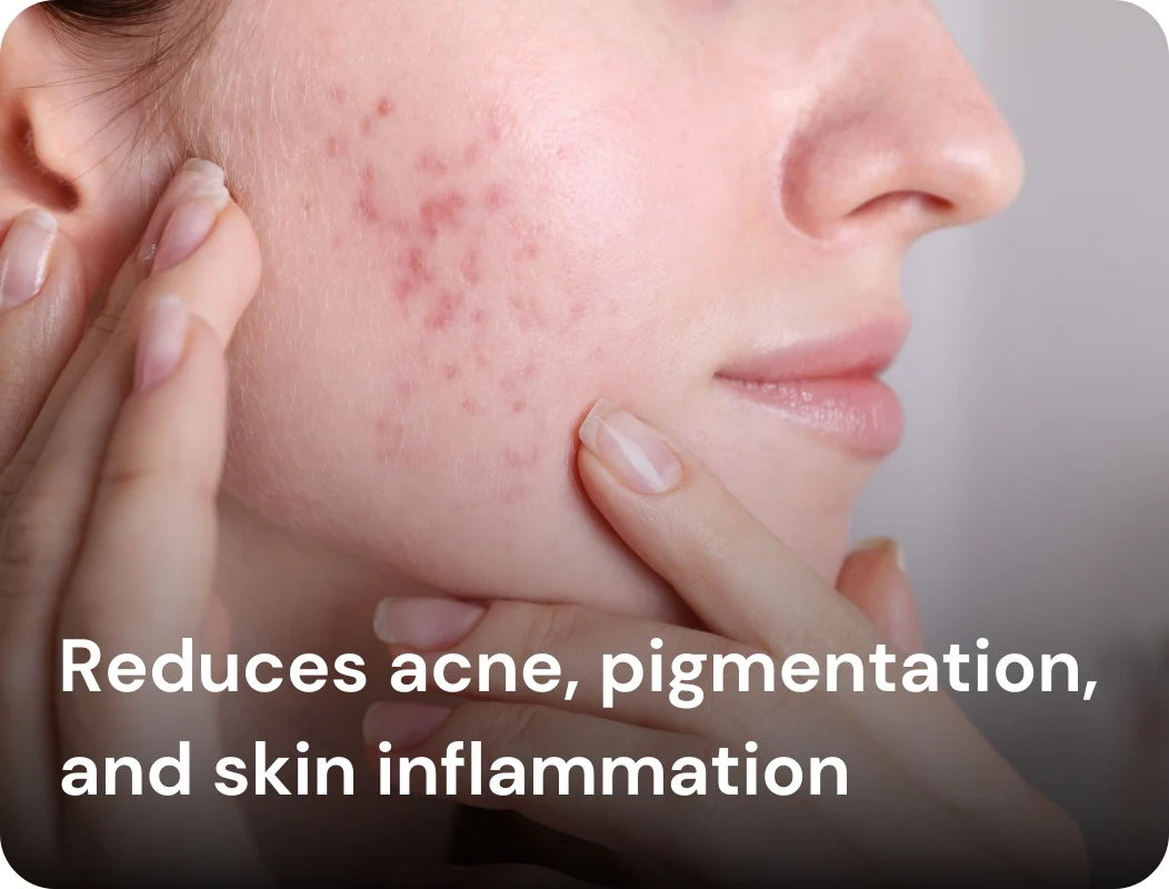 Reduces acne, pigmentation, and skin inflammation